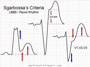 Sgarbossa kriterierna