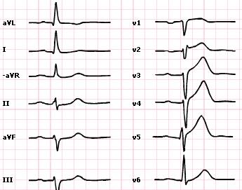 Anterior STEMI