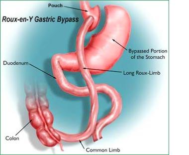 Gastric bypass