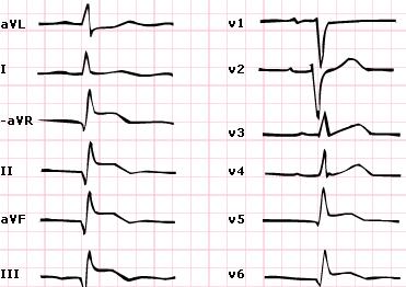 Inferior STEMI