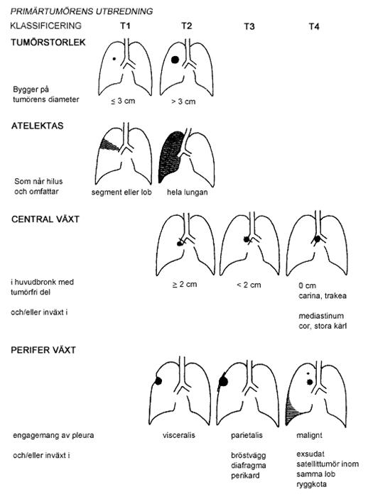 Stadieindelning vid lungcancer