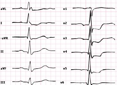 Posterior STEMI