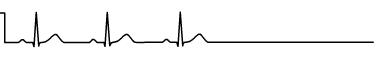 Sinus arrest